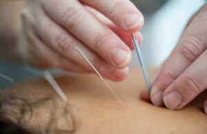 acupuncture for acute pain